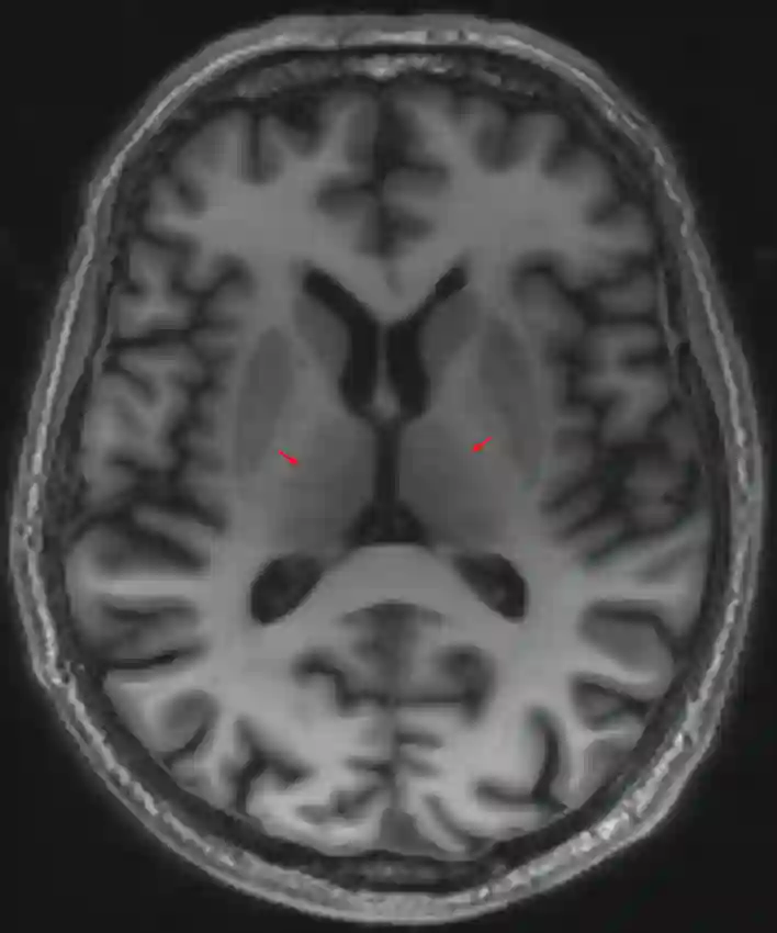 Thalamus im MRI