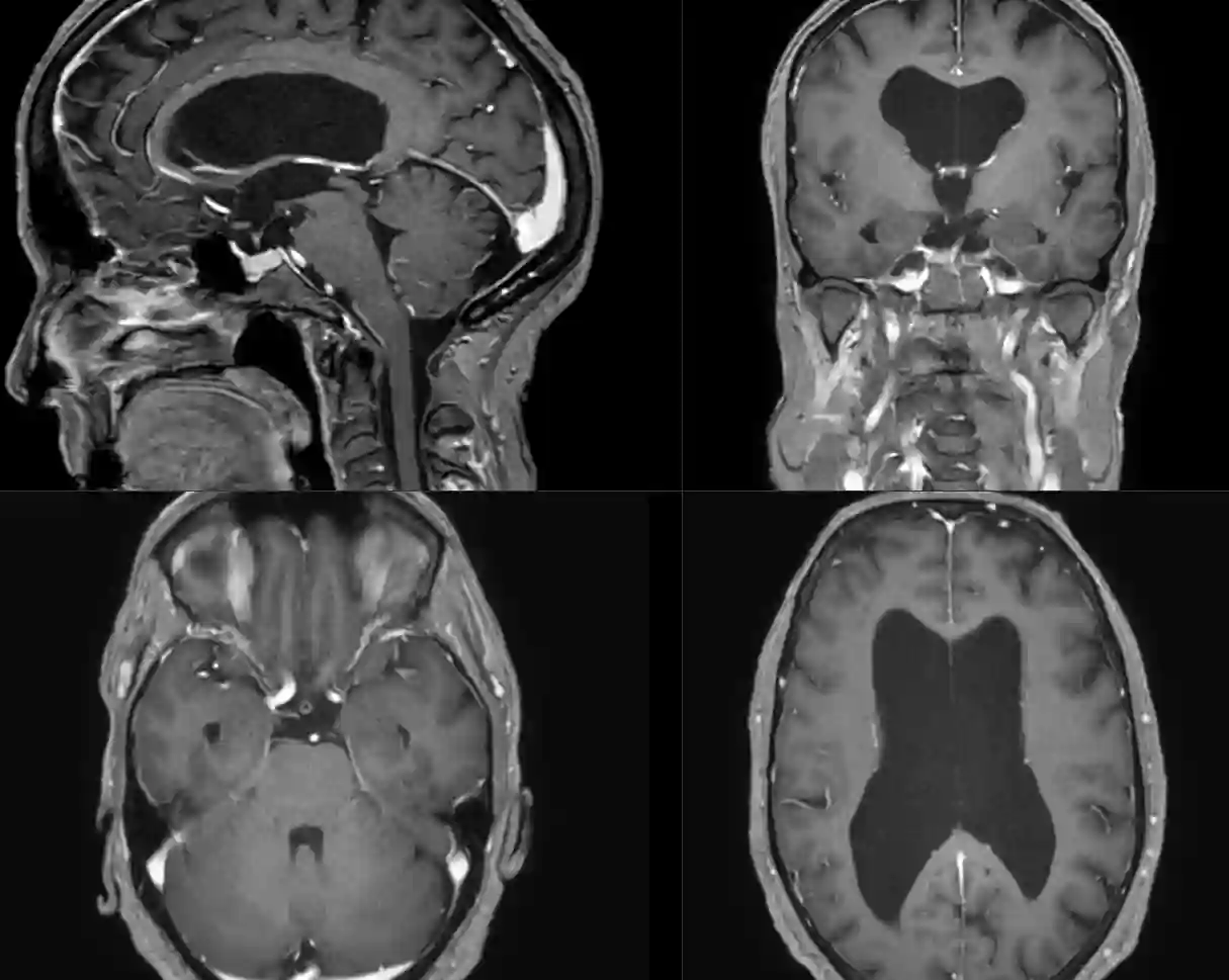 Triventrikulärer Hydrocephalus im MRi