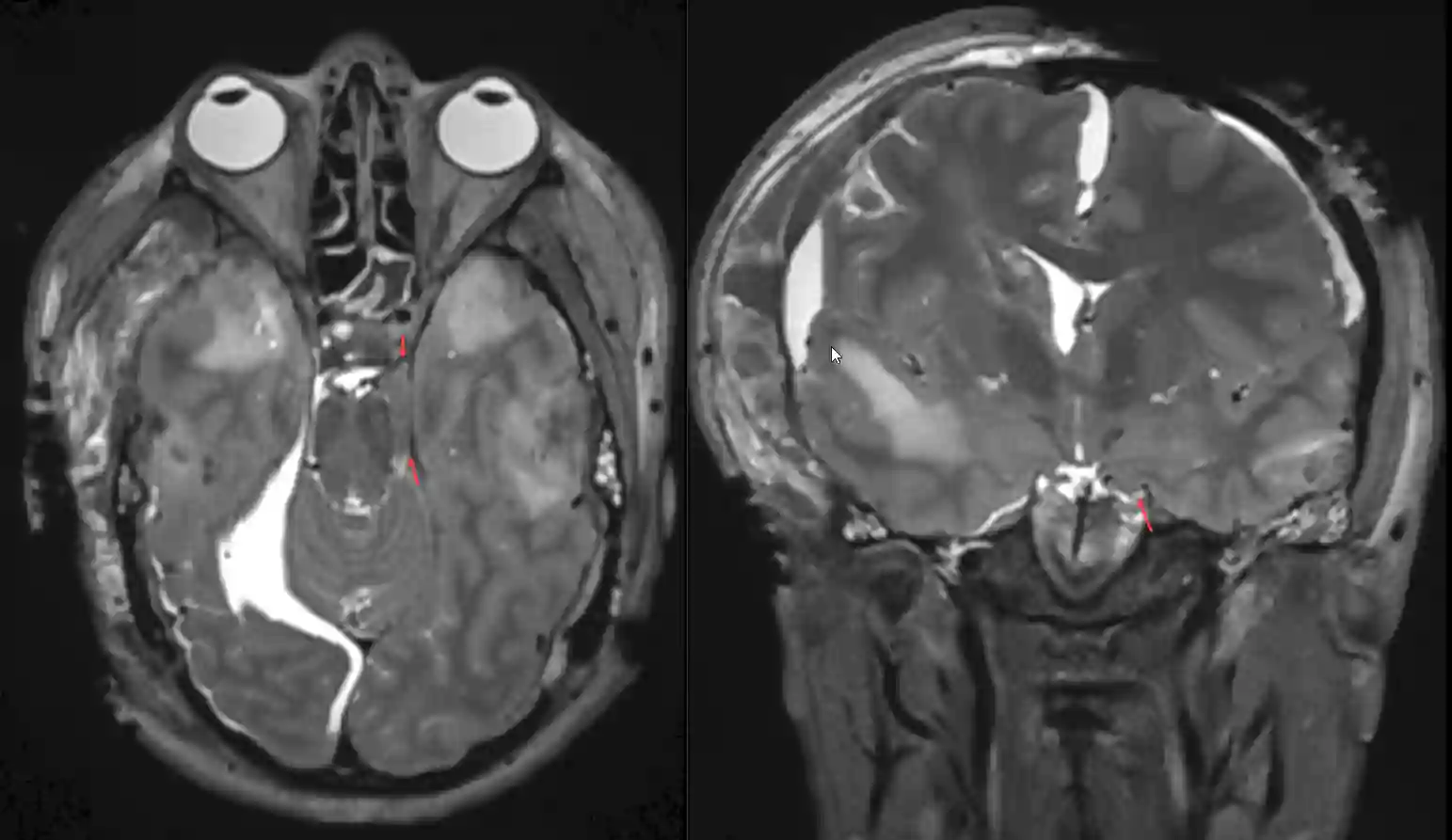Unkale Herniation im MRi