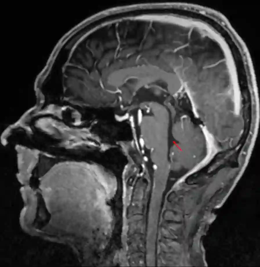 Vierter Ventrikel im MRI