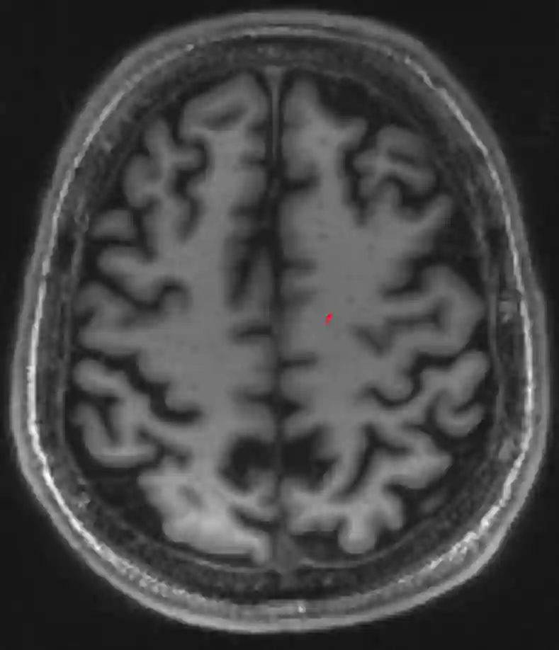 Weiße Substanz im MRI