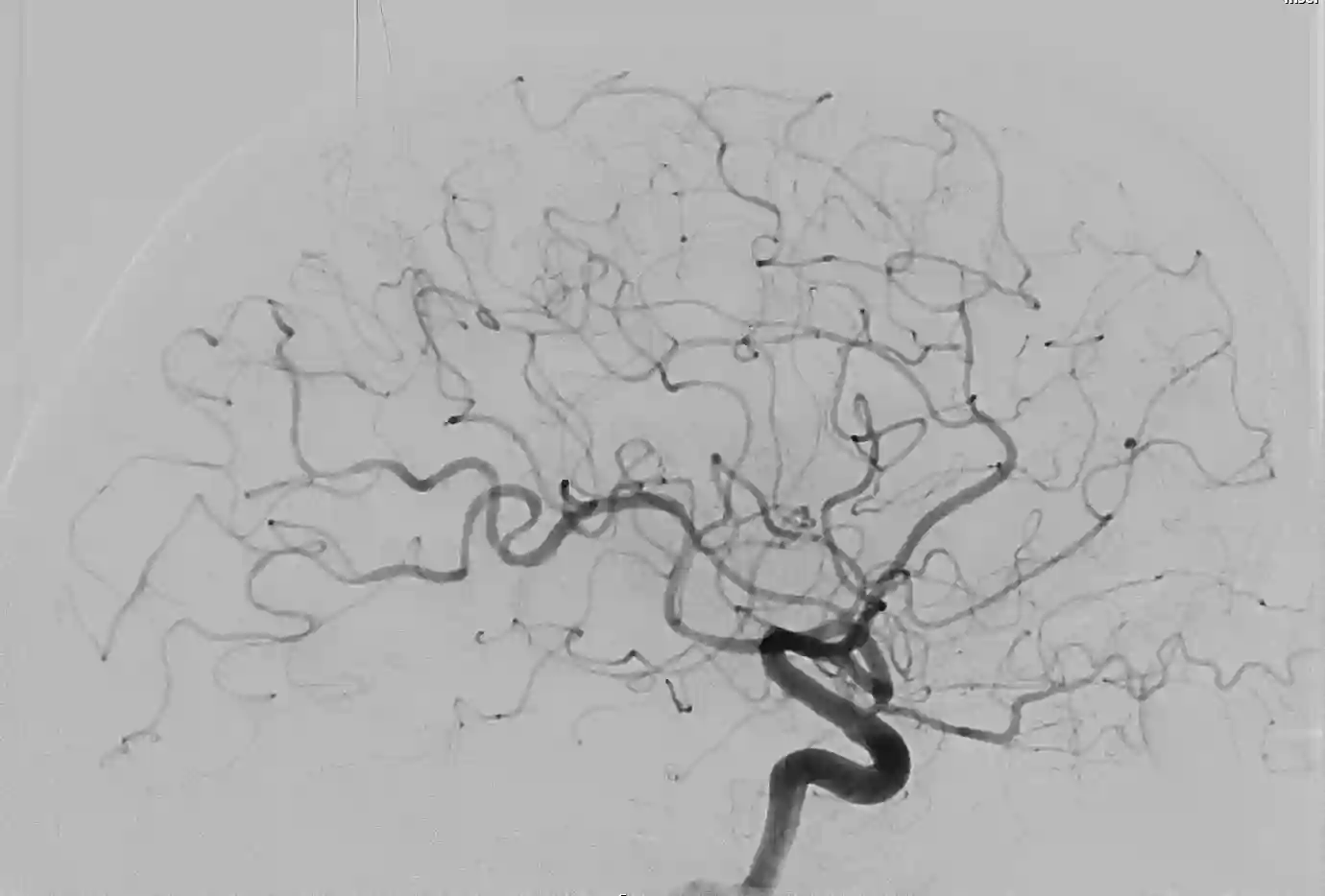 Digitale Subtraktionsangiographie einer zerebralen Vaskulitis