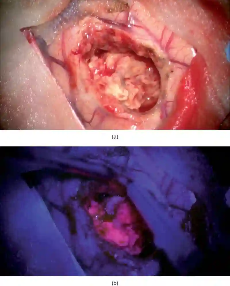 5-Ala Hirntumor