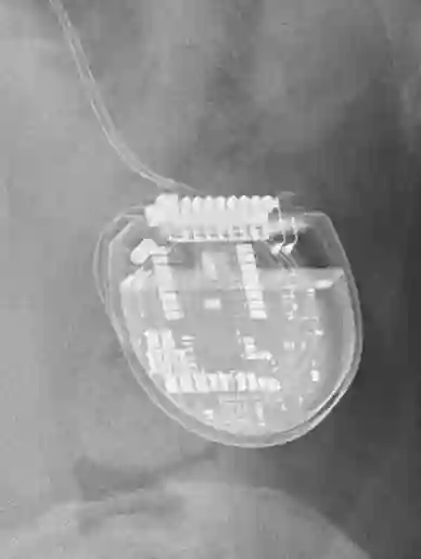 Neurostimulator Röntgen
