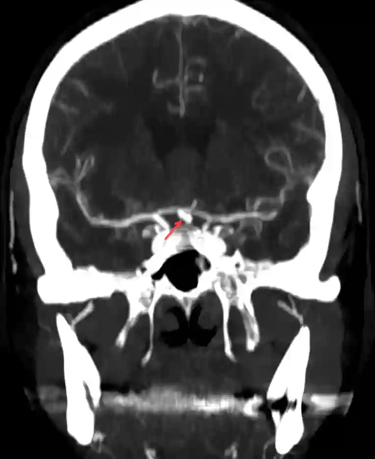 ACOM Aneurysma CT-Angiographie