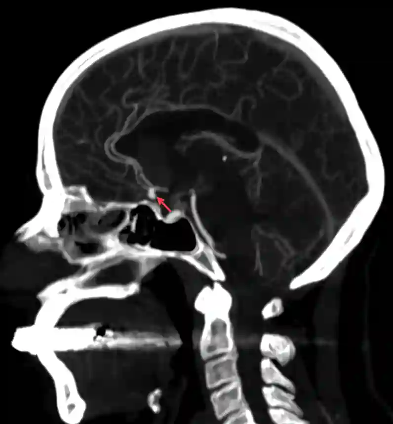 ACOM Aneurysma CT Angiographie