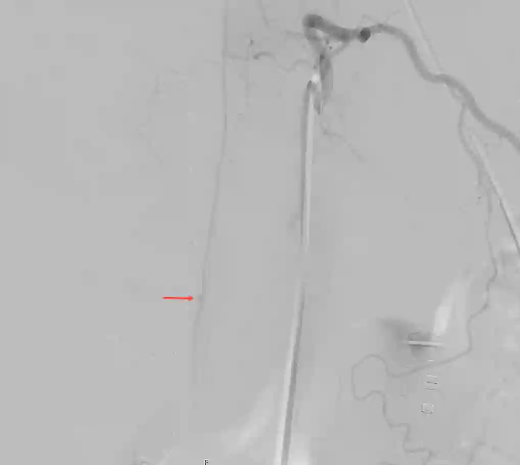Arteria spinalis anterior Aneurysma Angiographie