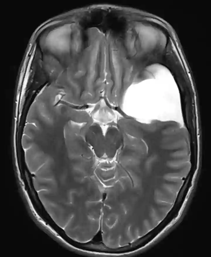 Arachnoidalzyste im MRI.