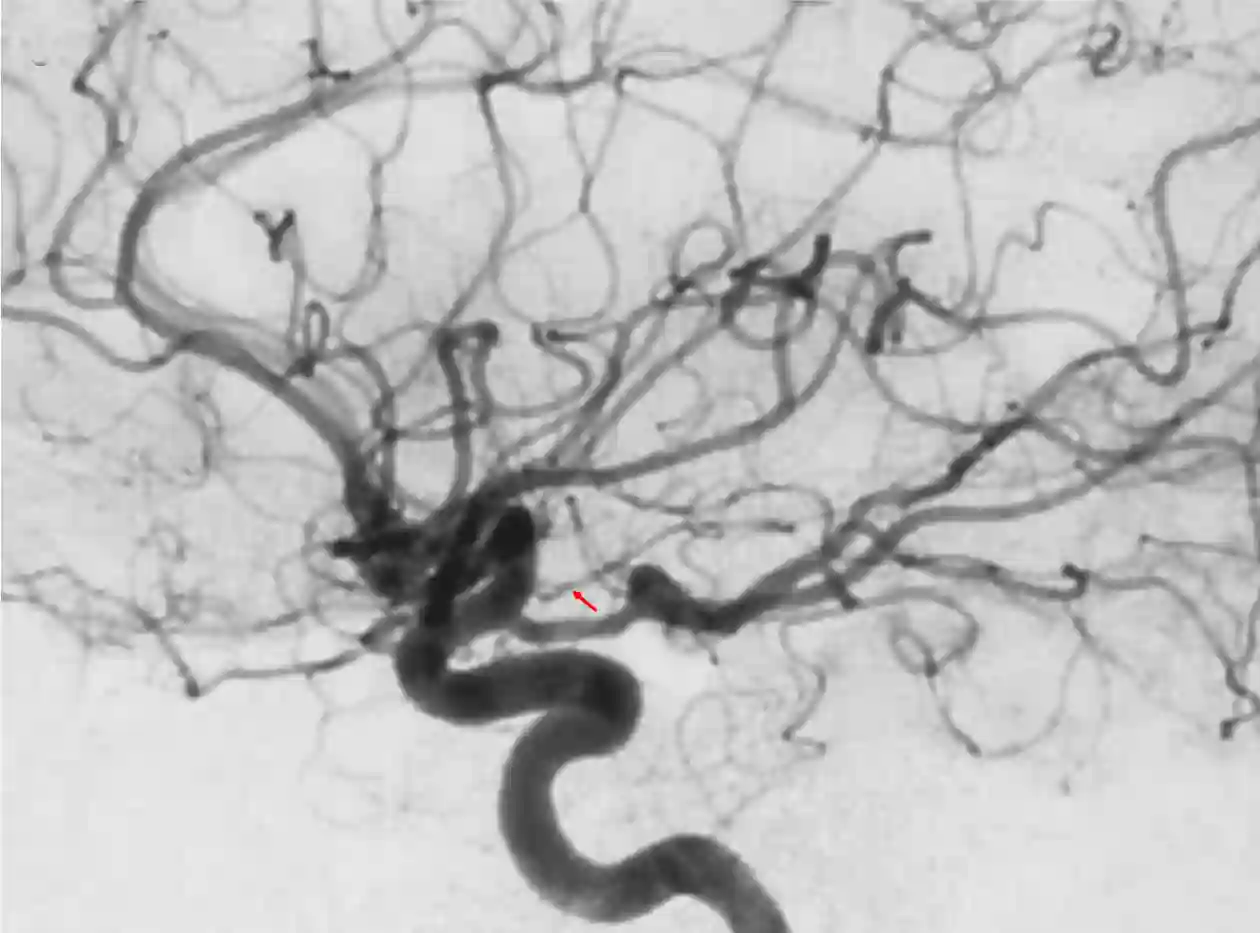 Arteria choroidea anterior Angiographie