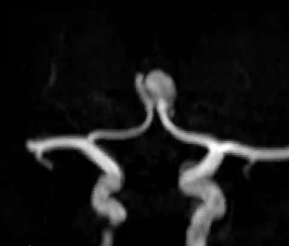 Arteria communicans anterior Aneurysma MR Angiographie