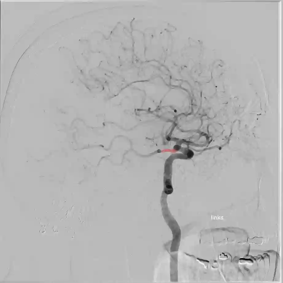 Arteria communicans posterior DSA
