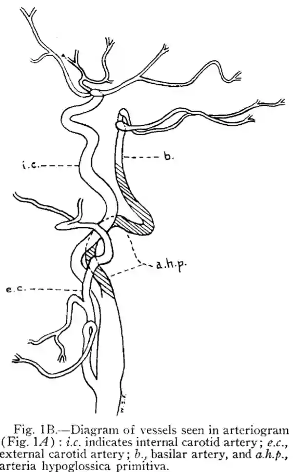 Arteria hypoglossica primitiva