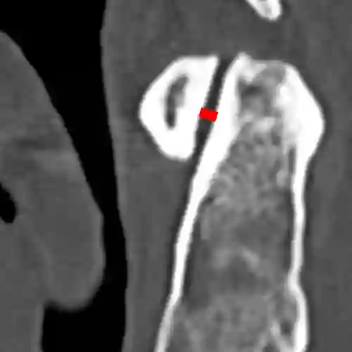 Atlantodentales Intervall (ADI) CT