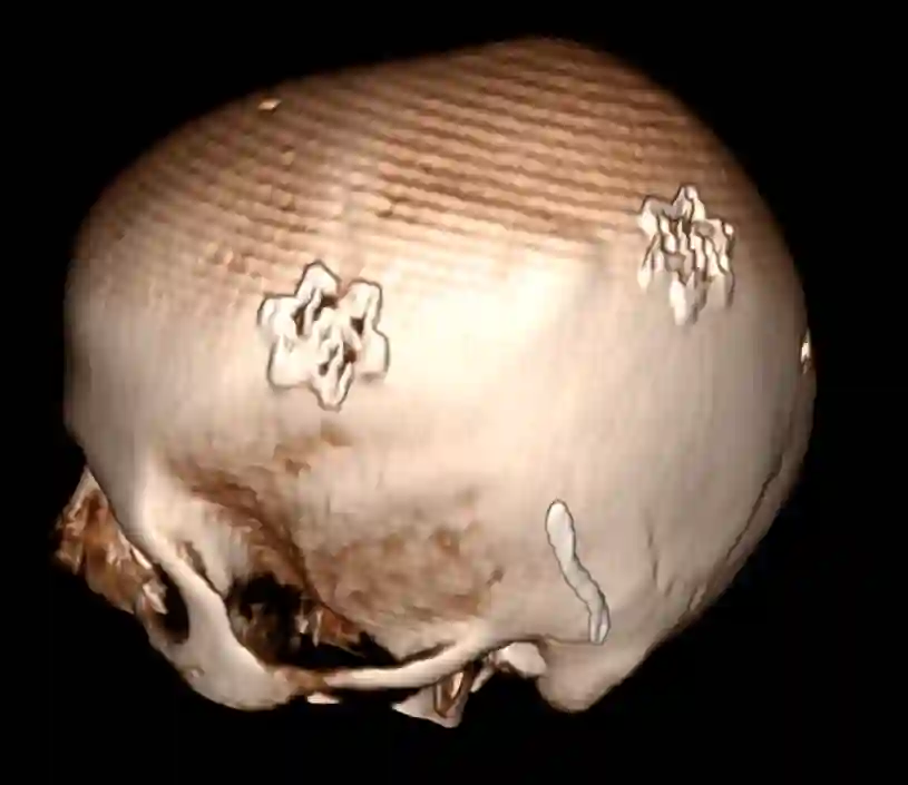 Bohrlochtrepanation