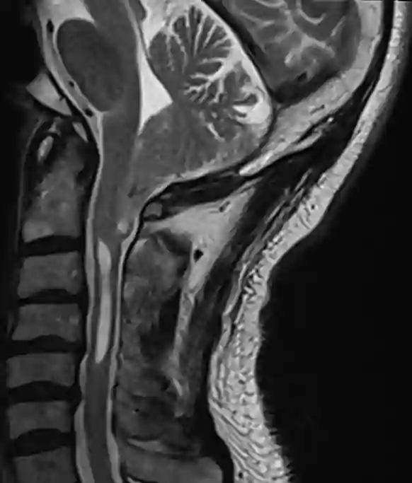 Chiari I Malformation MRI