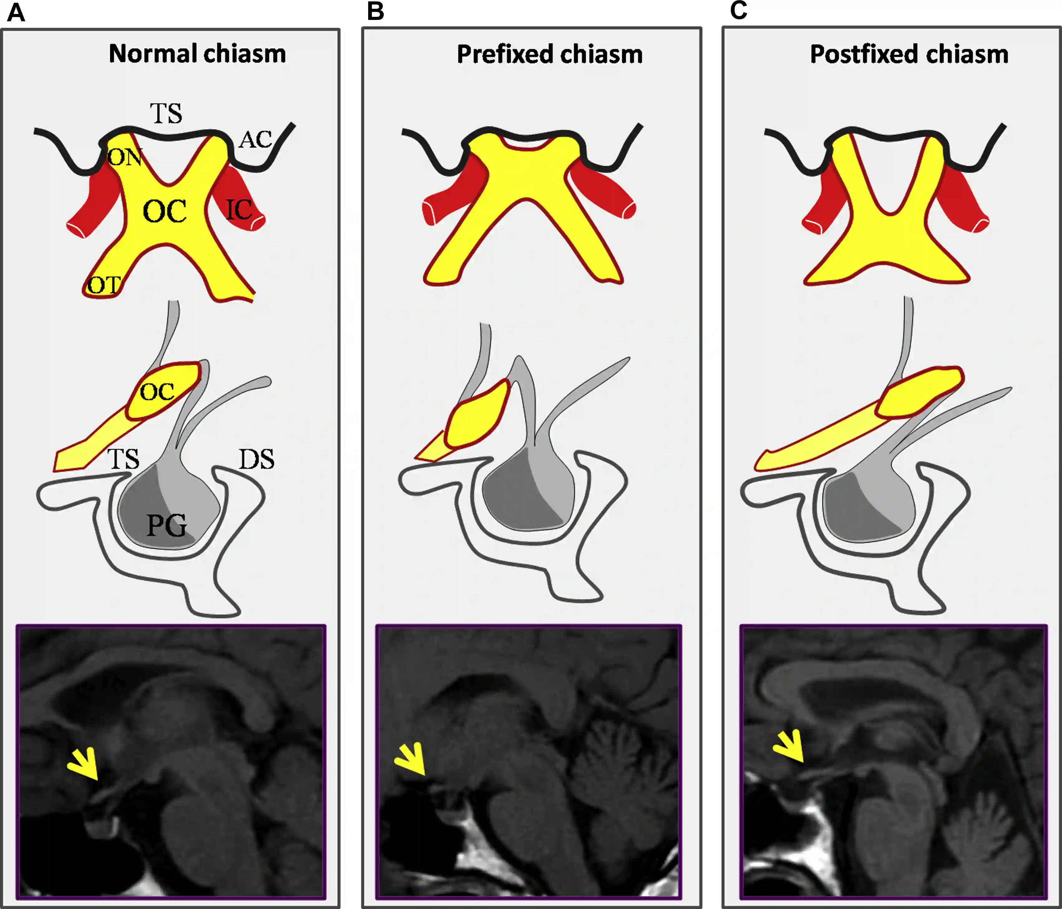 Anatomische Variationen des Chiasma opticum