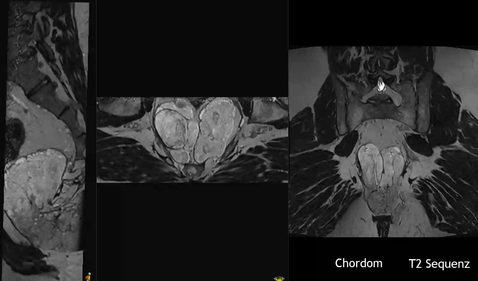 Sakrales Chordom im MRI