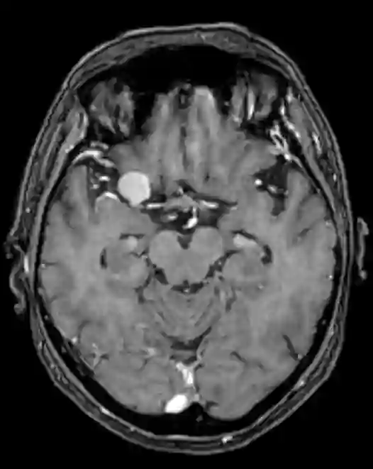 Processus clinoideus anterior Meningeom MRI
