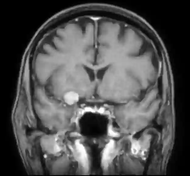 Processus clinoideus anterior Meningeom MRI
