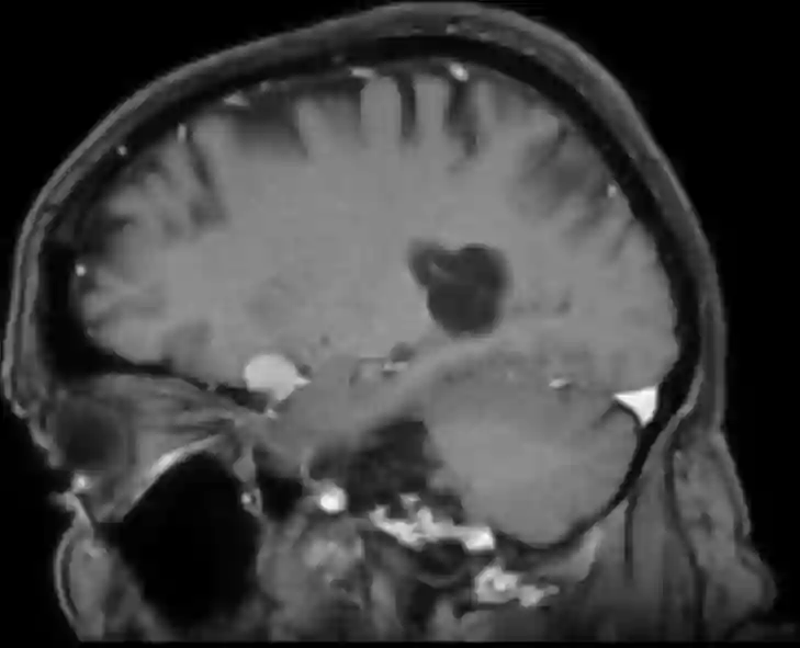 Processus clinoideus anterior Meningeom MRI