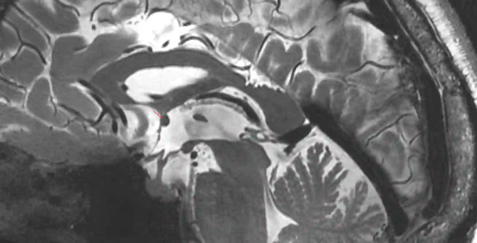 Commissura anterior im MRI