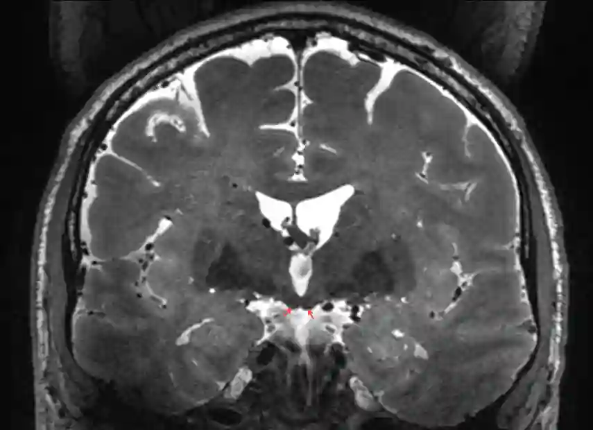 Corpus mamillare im MRI