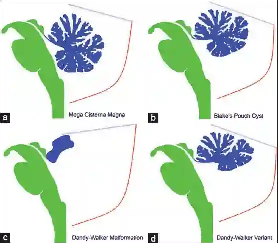 Varianten des Dandy-Walker Komplex