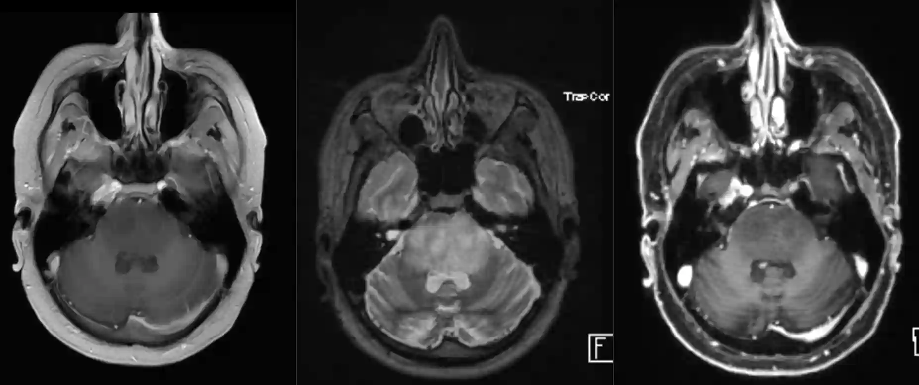 Diffuses intrinsiches pontines Gliom - DIPG