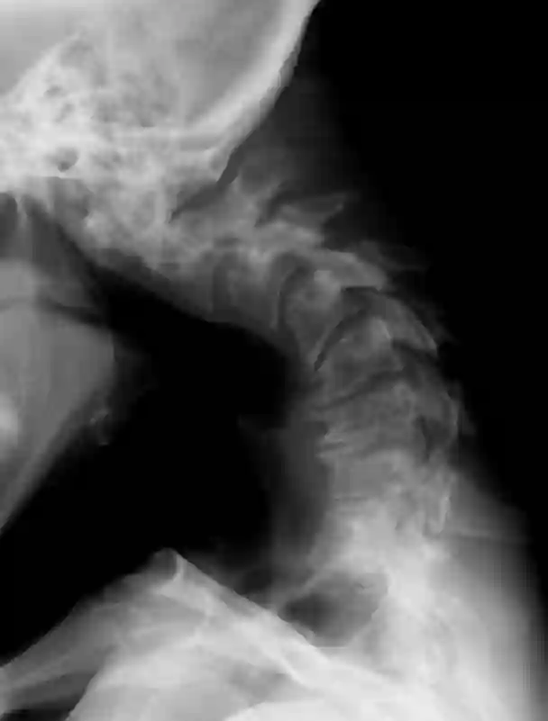 Dropped Head Syndrome X-ray