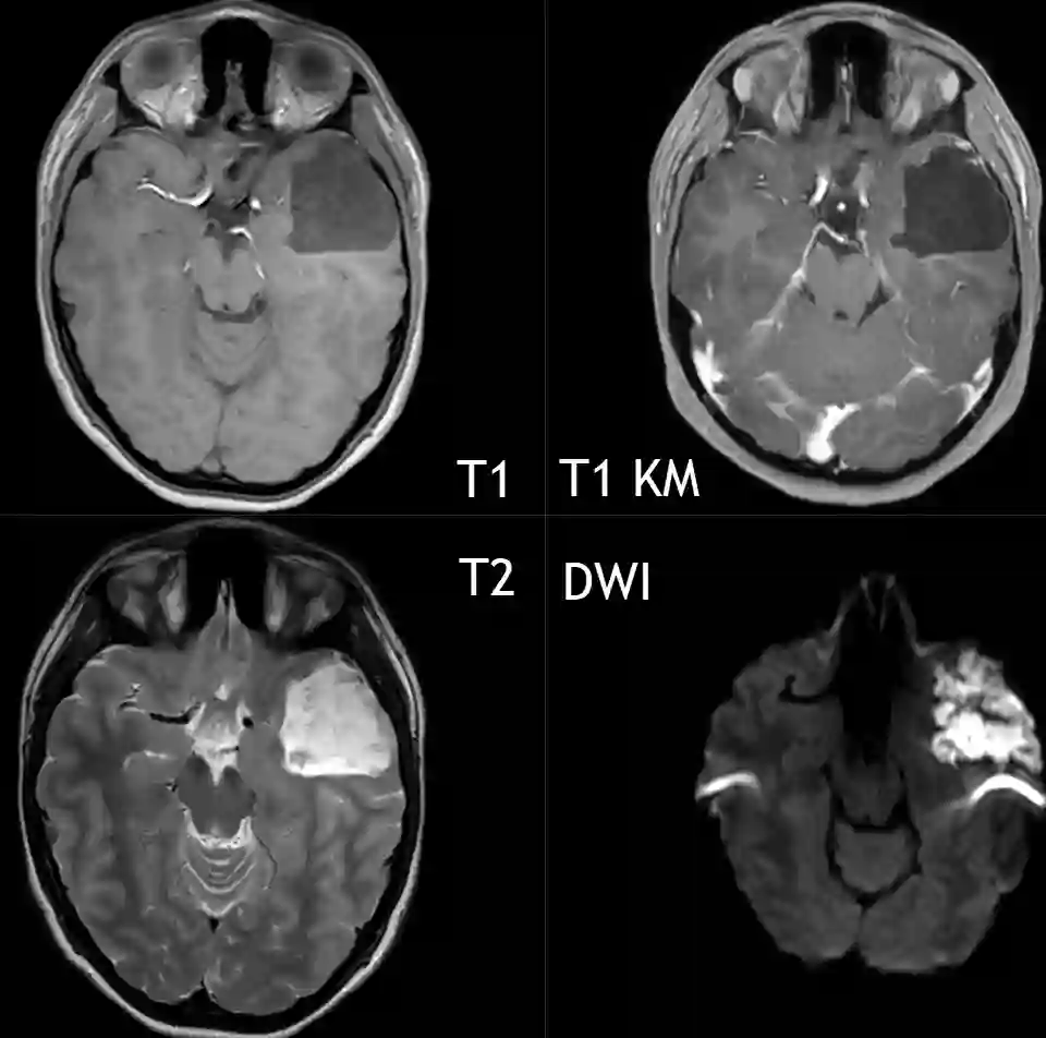 Intrakranielles Epidermoid im MRI