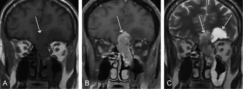 Esthesioneuroblastom im MRI