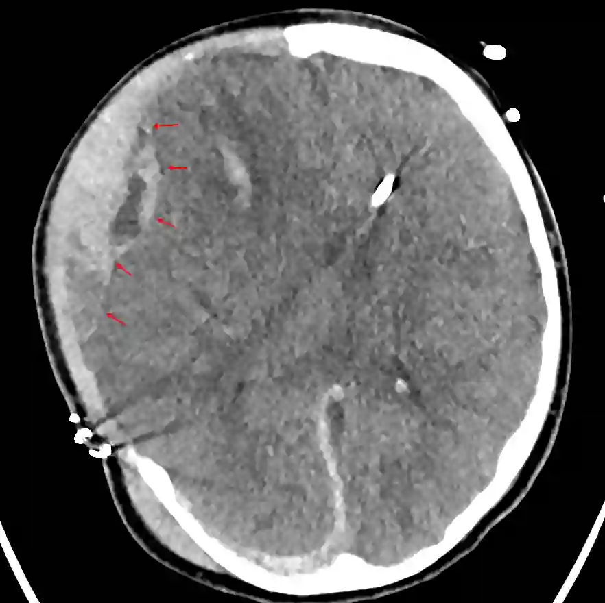 Extra-axiale Nachblutung nach Hemikraniektomie