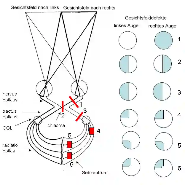 Lokalisation von Gesichtsfeldausfällen