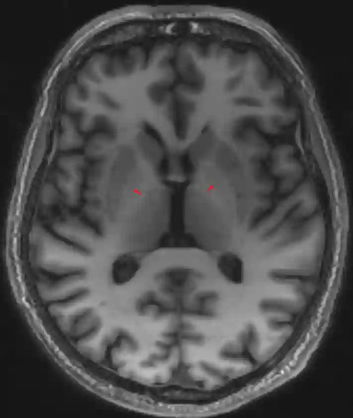 Globus pallidus MRI