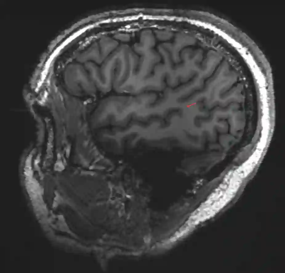 Gyrus angularis im MRI