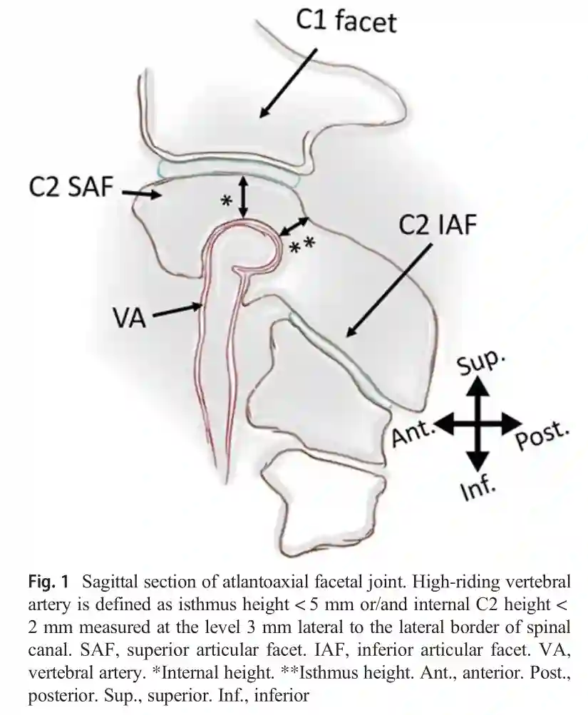 High-riding Arteria vertebralis schematisch