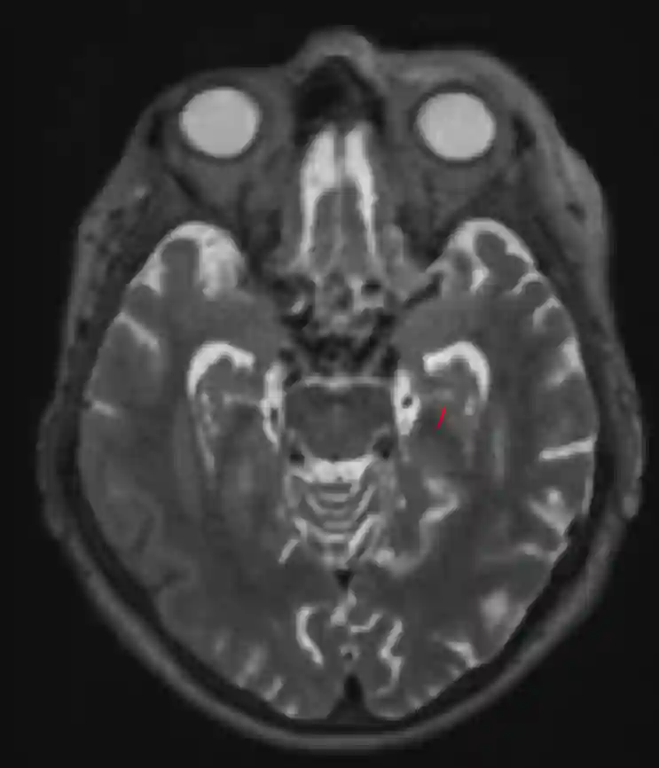 Hippocampal remnant cyst