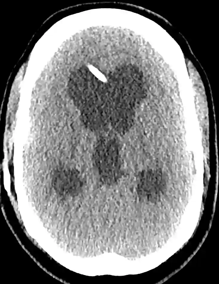 CT Shuntdysfunktion Hydrocephalus