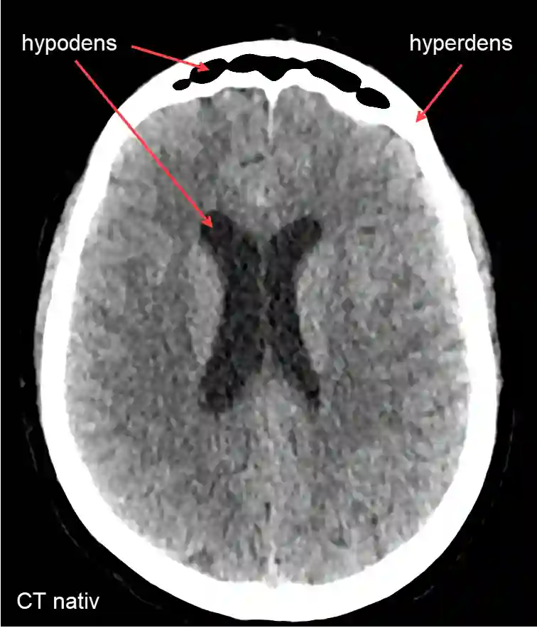 Hypodensität und Hyperdensität im CT