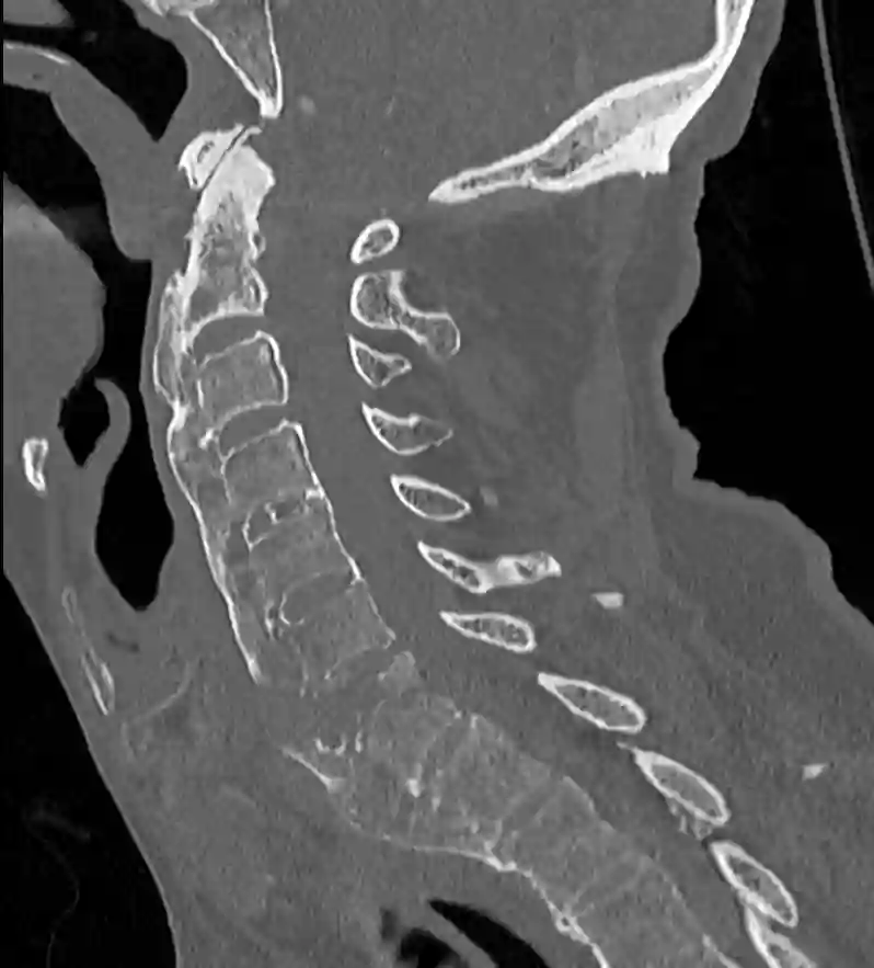 hyperextensions Distraktion Verletzung im CT