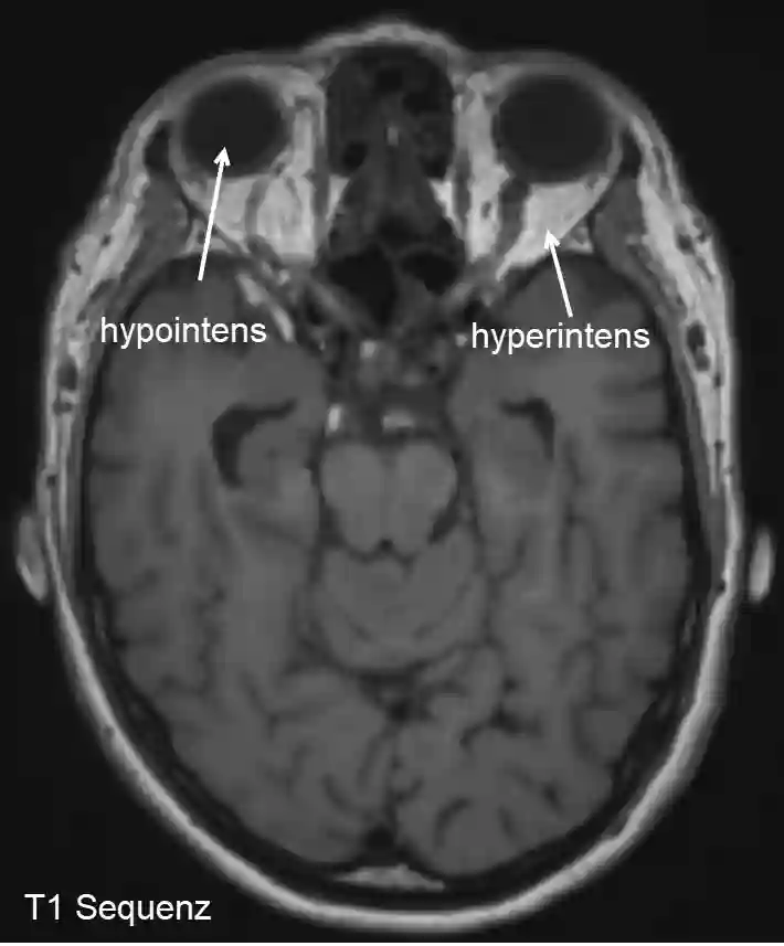 Hyperintensität und Hypointensität im MRI
