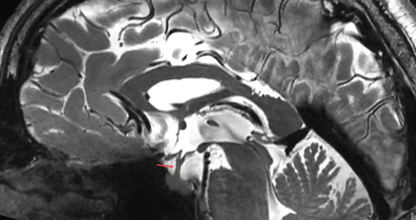 Hypophysenstiel im MRI