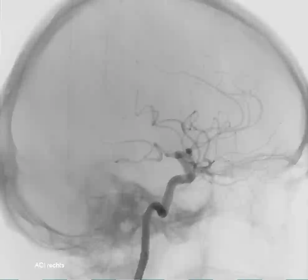 ICA Angiographie mit Knochen