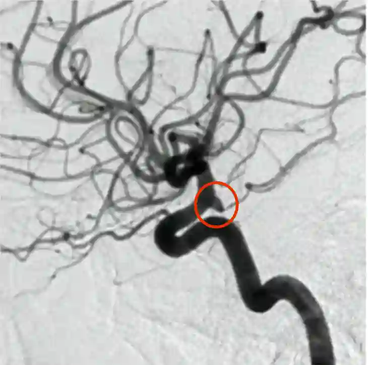 Infundibulärer Arterienabgang DSA