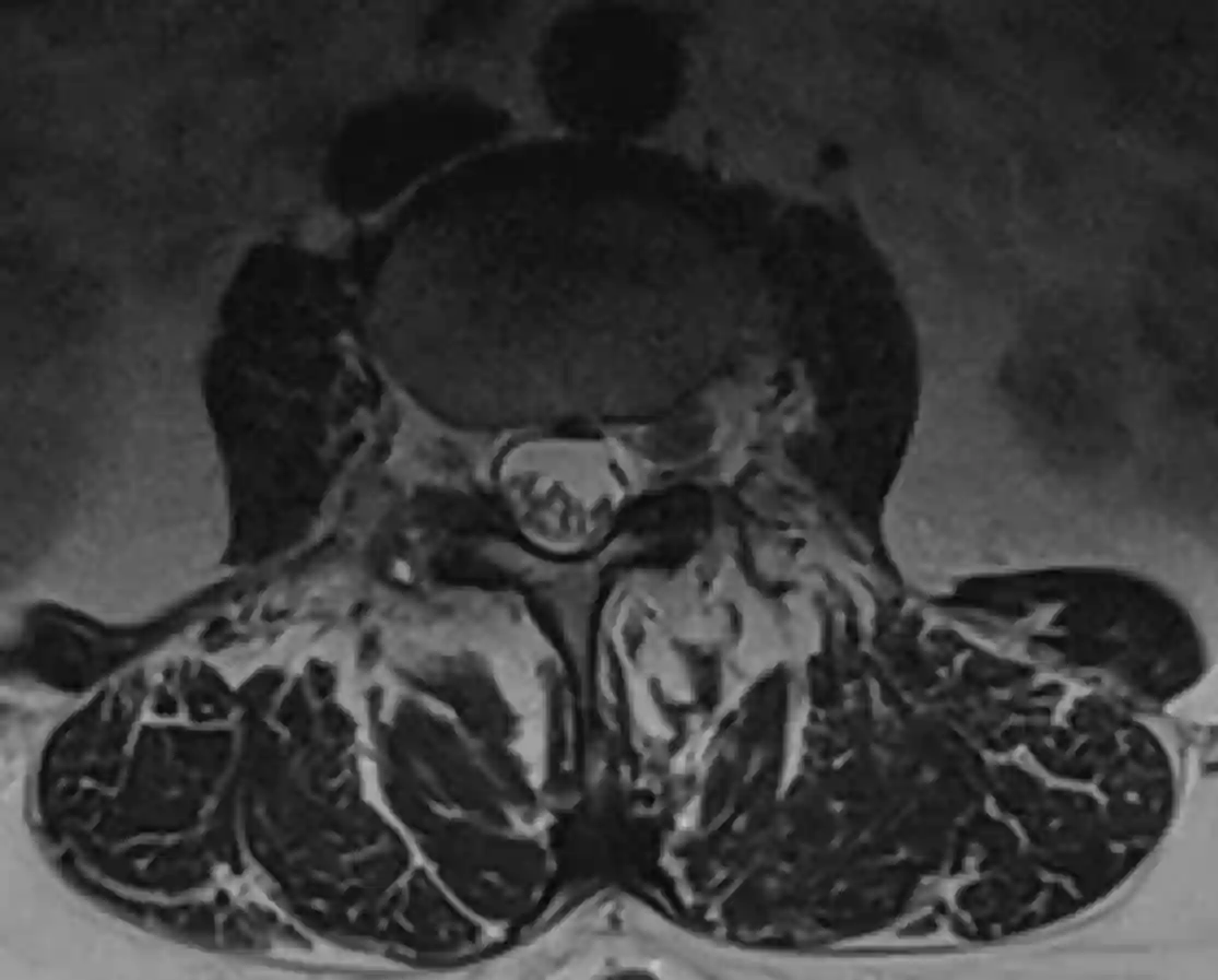 Intraforaminaler Bandscheibenvorfall im MRi