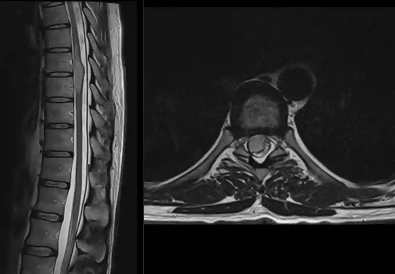 Intramedulläre Raumforderung MRI
