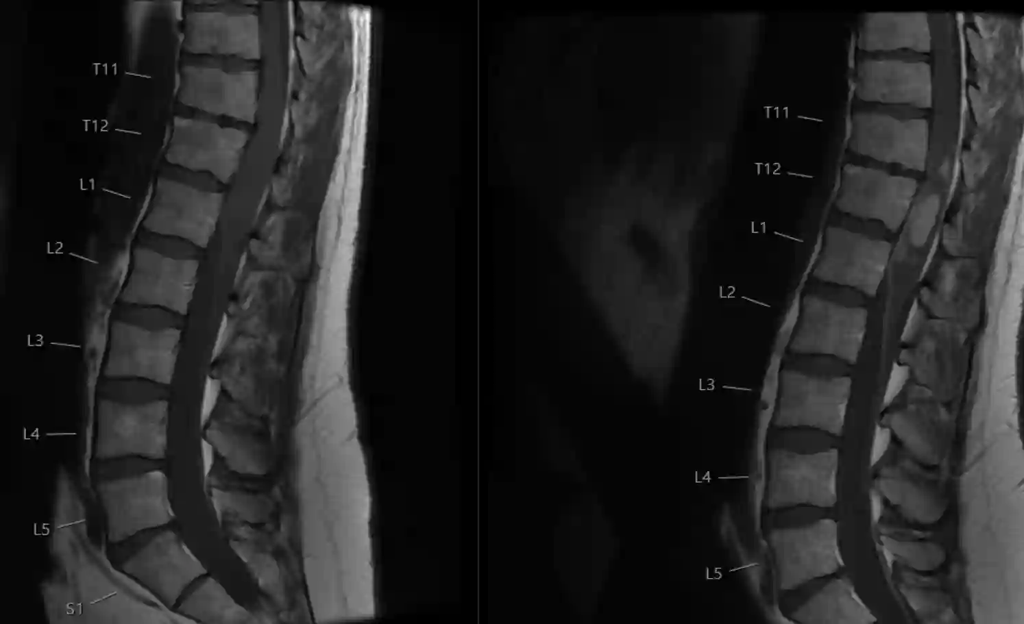 Intramedulläres diffuses Mittelliniengliom WHO Grad 4 im MRI
