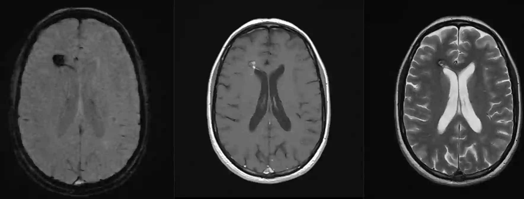Kavernom MRI