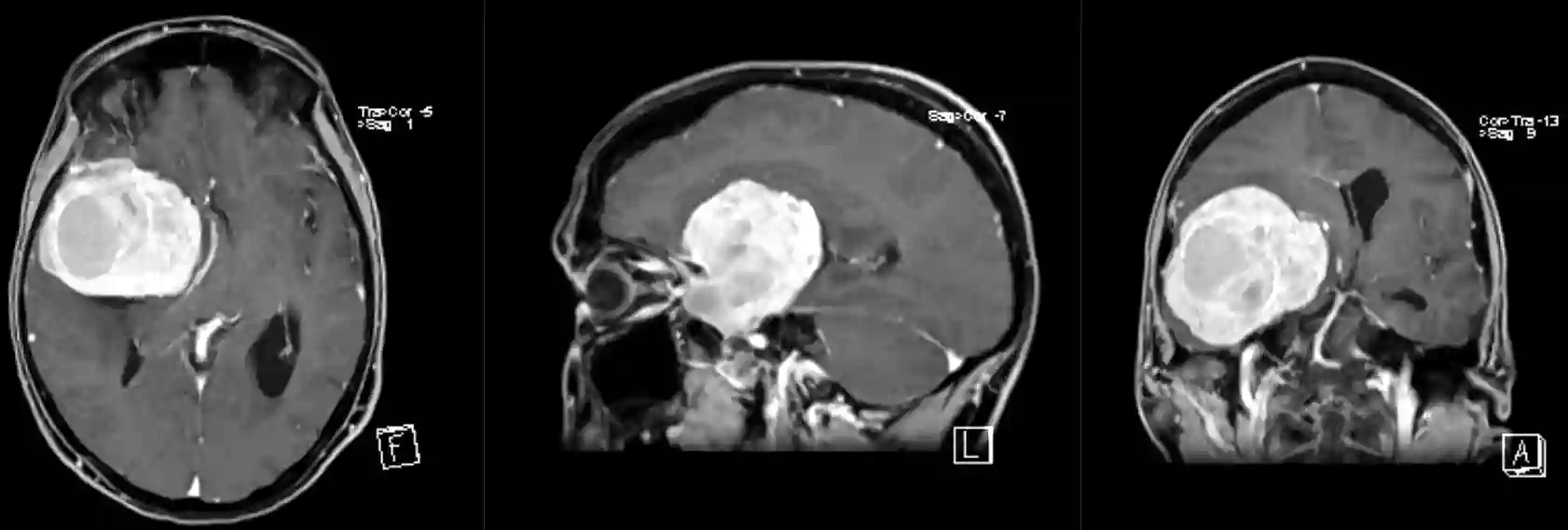 Keilbeinflügelmeningeom MRI