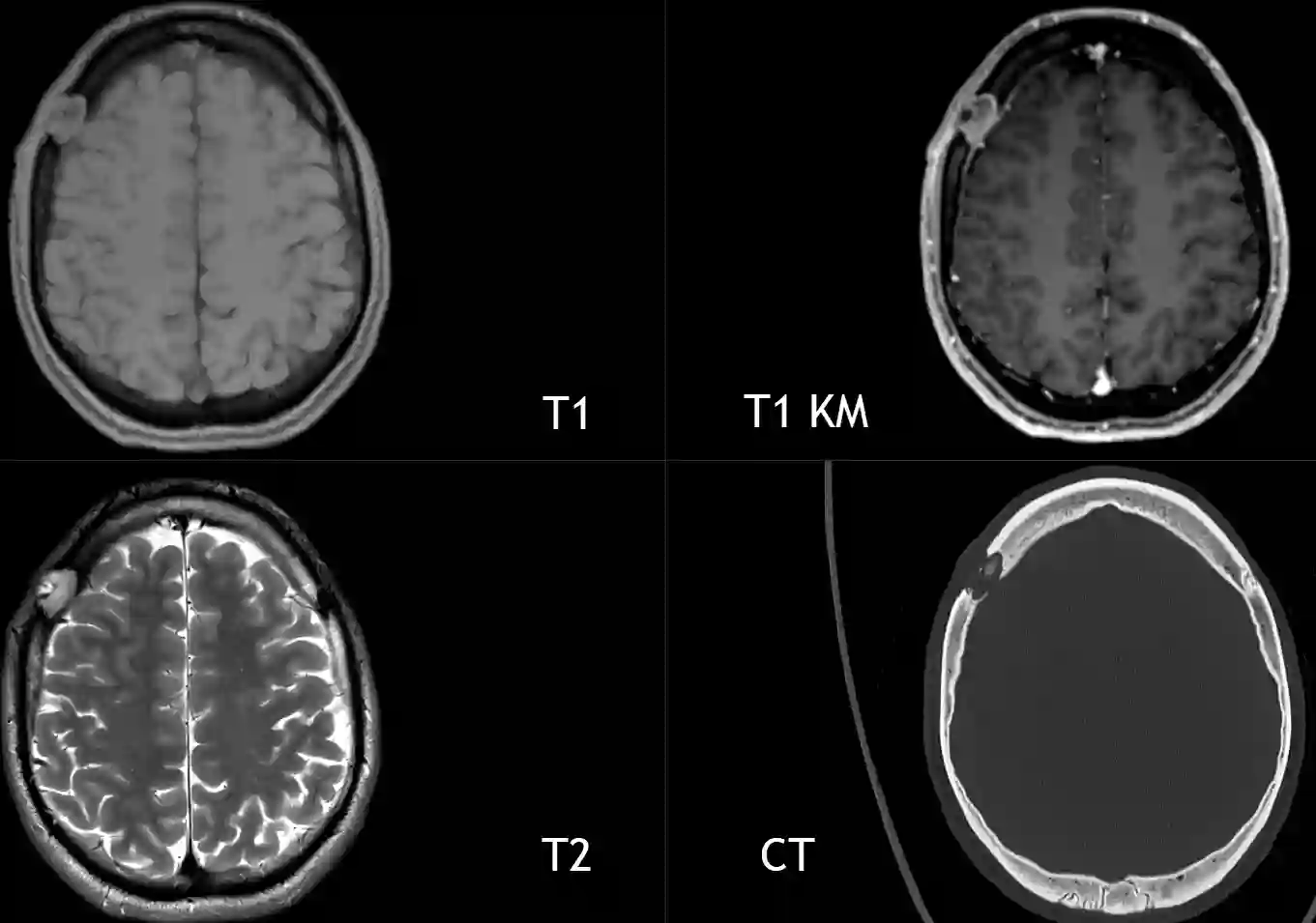 CT und MRI einer intrakraniellen Langerhans-Zell-Histiozytose